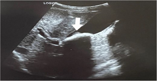 Axial view; ultrasonography of the gallbladder shows sludge with the stone formations (white arrow).