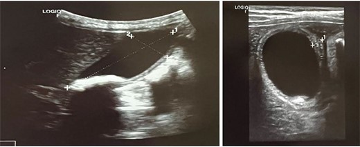 Axial and transverse ultrasonography view, sure wall thickness, and pericholecystic oedema.