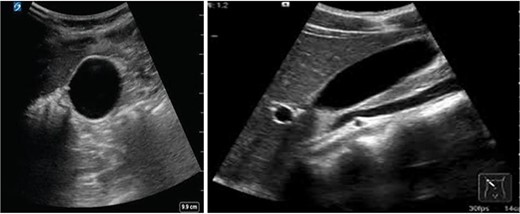 Normal gallbladder ultrasound after the drug discontinuation.