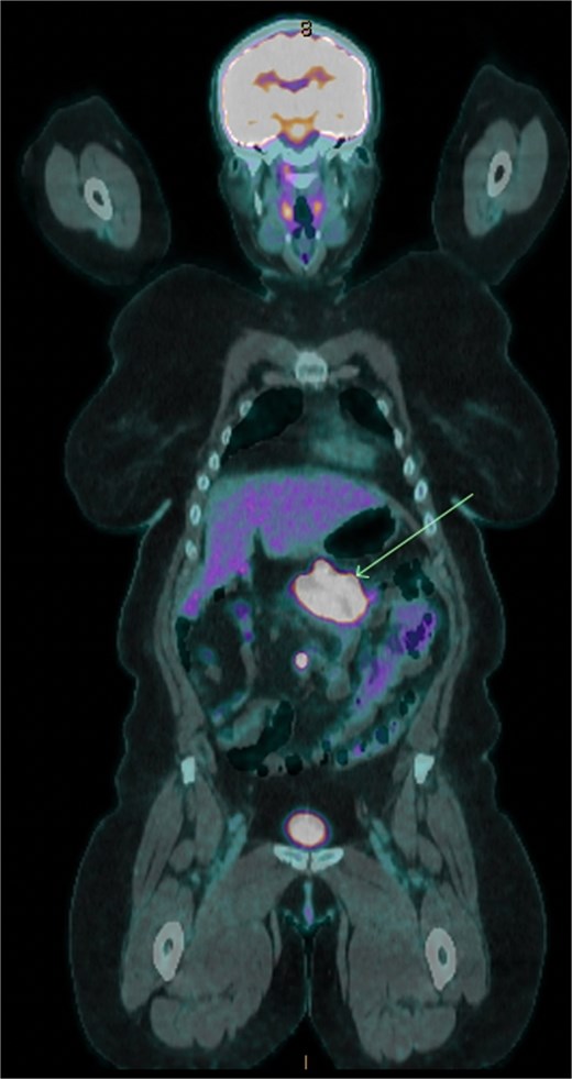 18F-FDG positron emission tomography/computed tomography showing transverse colonic recurrence (arrow).