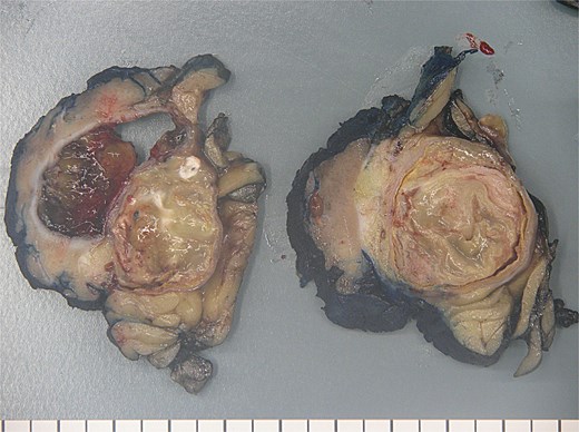 Renal mucinous cystadenoma pathology.