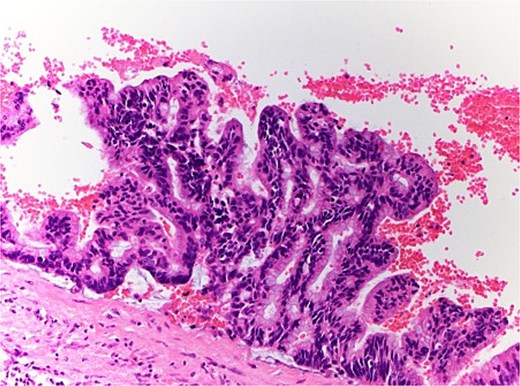 Microscopic pathology of renal mucinous cystadenoma.