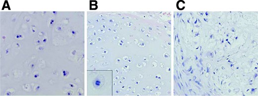 Histology of grade I, II, and III chondrosarcoma. While cellularity is low in grade I chondrosarcoma (A) with chondroid matrix and absent mitoses, in grade II chondrosarcoma (B) mitoses are found (inset). In grade III chondrosarcoma (C), a high cellularity with muco-myxoid matrix changes is seen with cytonuclear atypia (hematoxylin and eosin staining, ∼500×).