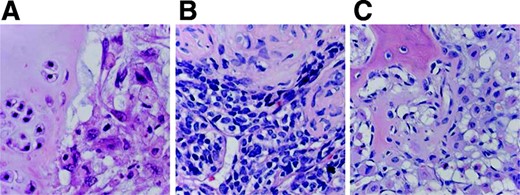 Histology of rare chondrosarcoma subtypes. (A): Histology of dedifferentiated chondrosarcoma with a sharp interface between conventional chondrosarcoma (left) and anaplastic sarcoma (right). (B): Mesenchymal chondrosarcoma with undifferentiated small blue round cells (below) and cartilage differentiation (top). (C): Clear cell chondrosarcoma demonstrating chondrocytes with abundant clear cytoplasm, cartilaginous matrix, and deposition of osteoid. (hematoxylin and eosin staining, ∼500×)