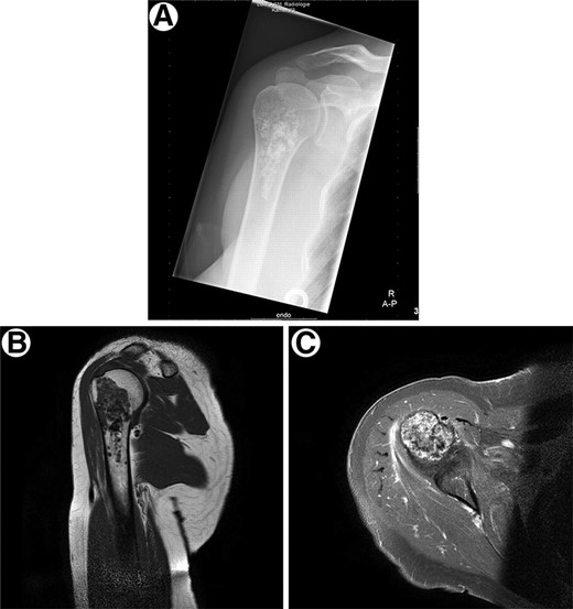 Radiological presentation of a conventional low-grade chondrosarcoma. (A): Conventional low-grade chondrosarcoma in the proximal humerus with chondroid mineralization on conventional radiograph. (B): Discrete endosteal scalloping of the anterior cortex is seen on the T1-weighted magnetic resonance image. (C): Axial T1-weighted magnetic resonance image with fat suppression after i.v. contrast injection demonstrates the typical peripheral ring-and-arc pattern of enhancement. No soft tissue extension is noted.