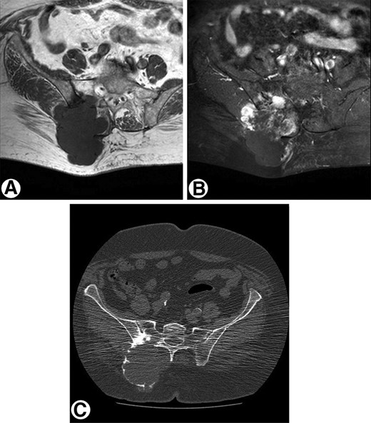 Radiological presentation of a high-grade pelvic chondrosarcoma. (A): Axial T1-weighted magnetic resonance image of high-grade chondrosarcoma arising from the pelvis with cortex destruction and a large soft tissue component. (B): Axial T1-weighted magnetic resonance image with fat suppression after i.v. contrast injection shows areas of solid peripheral enhancement. (C): Computed tomography image demonstrates the bone destruction of the right os ilium and os sacrum with a large soft tissue mass with only peripheral mineralization.