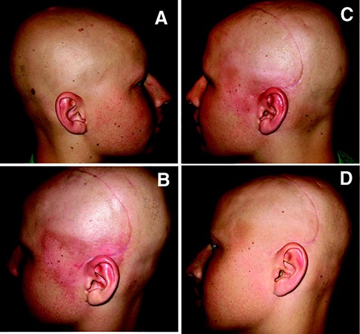 Radiation-induced skin changes. Images of nonirradiated side of head (A) and irradiated side of head (B–D). (B) and (C) were taken 31 and 40 days, respectively, after the start of radiation. (D) was taken 1 month after the end of radiation. (B) represents the worst of the radiation-induced skin changes.