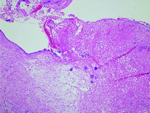 Gastrectomy specimen. SIR-Spheres® can clearly be seen within the gastric mucosa in close proximity to a clean-based ulcer. Magnification, 10×; hematoxylin and eosin stain.