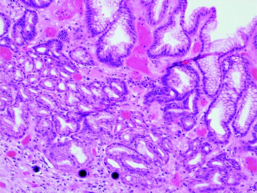Gastrectomy specimen. SIR-Spheres® are visualized as round, purple orbs within lamina propria vessels in the gastric mucosa. Magnification, 20×; hematoxylin and eosin stain.