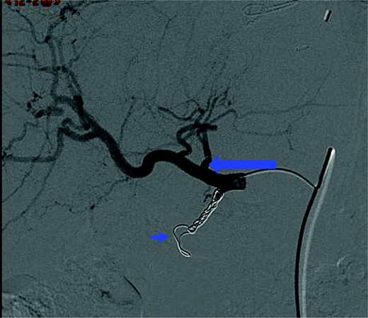 Pretreatment hepatic arteriogram illustrating the accessory right gastric artery (large arrow) branching off the left hepatic artery, with coils in place in the gastroduodenal artery (short arrow).