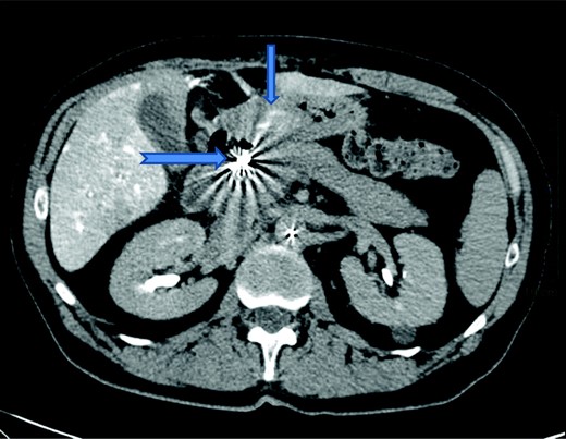 Computed tomography hepatic angiogram revealing enhancement of the gastric mucosa (small arrow) with coils seen in situ in the gastroduodenal artery (large arrow).