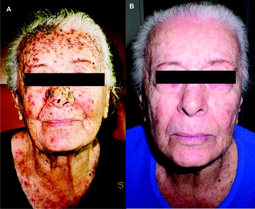 Early-phase papulopustular eruption on the face, National Cancer Institute Common Toxicity Criteria grade 2–3 severity. (A) Before treatment. (B) One week after topical treatment.