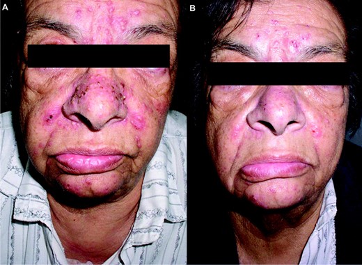 Early-phase papulopustular eruption on the face, National Cancer Institute Common Toxicity Criteria grade 1 severity. (A) Before treatment. (B) One week after topical treatment.