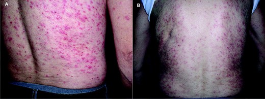 Late-phase papulopustular eruption on the back, National Cancer Institute Common Toxicity Criteria grade 3 severity. (A) Before treatment. (B) Five days after treatment with oral ofloxacin.