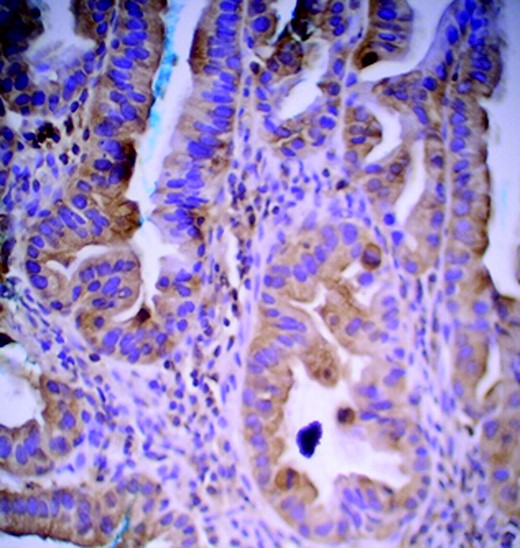 Cytoplasmic stains of phosphorylated mammalian target of rapamycin showing overexpression in 40% of adenocarcinoma cells (magnification, 20×).