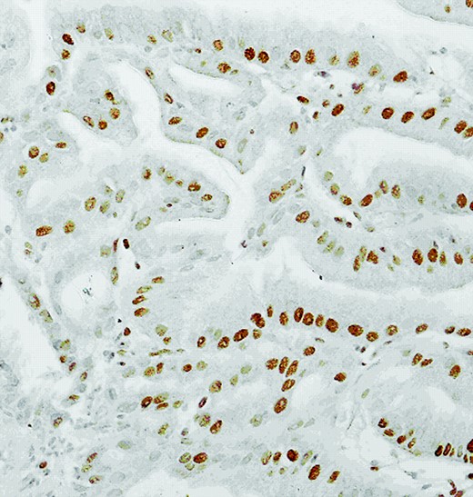 Nuclear stains of vascular endothelial growth factor receptor showing overexpression in 60% of adenocarcinoma cells (magnification, 20×).