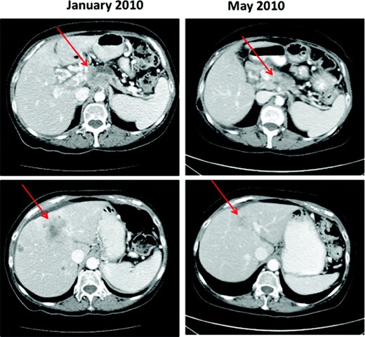 IV期胰腺癌和BRCA1突变患者：吉西他滨加聚（ADP‐核糖）聚合酶抑制剂的疗效。