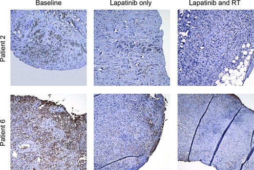 Representative micrographs showing phosphoHER2 staining at baseline (left), after 1 week of lapatinib (middle), and after 1 week of radiation and 2 weeks of lapatinib (right). Abbreviation: RT, radiotherapy.