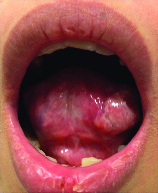 Left tongue squamous cell carcinoma.