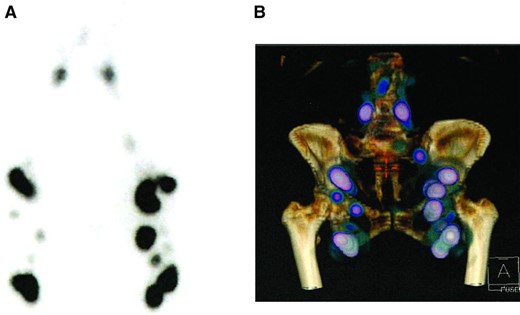 Preoperative single‐photon emission computed tomography lymphoscintigraphy with planar images (A) and three‐dimensional reconstruction of the lower limbs (B).