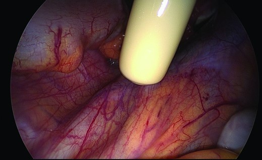 Intraoperative isotopic detection of lower‐limb drainage nodes in the pelvis.