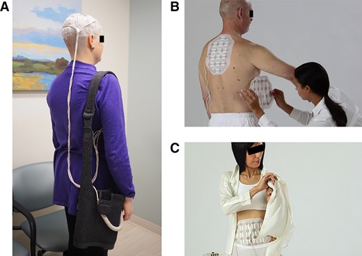 Example diagrams of patients with the tumor‐treating fields device. (A): A patient with the transducer arrays on shaved scalp and the portable battery in a shoulder bag. (B): Transducer arrays are placed on a patient's back for mesothelioma or lung cancer. (C): Transducer arrays are placed on abdomen or pelvis for ovarian cancer. Figure 1B and 1C are reproduced with permission from Novocure. © 2019 Novocure.