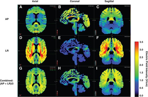 Example of calculated electric field distribution within the brain. The axial, coronal, and sagittal views of calculated electric field distributions for anterior‐posterior and left‐right transducer arrays as well as combined electric fields are shown, respectively.