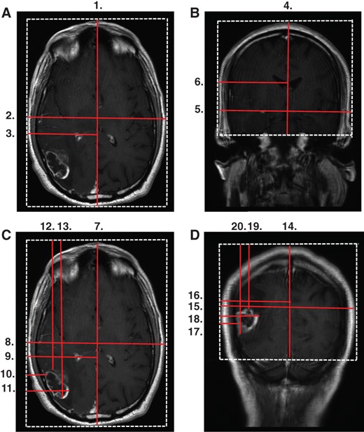 NovoTAL treatment planning using standard T1‐weighted postcontrast magnetic resonance imaging (MRI) image. The process is as follows. (A): Head size measurements 1–3 are obtained using the axial MRI slice directly above the superior edge of the orbit. Reference frame was drawn around the head at the outer margin of the scalp. (B): Head size measurements 4–6 are obtained using the coronal MRI slice at the level of external auditory canal. A reference frame was drawn with the bottom line at the level of inferior margin of the temporal lobe. (C): Tumor location measurements 7–13 are obtained using the axial MRI image showing the maximum diameters of enhancing tumor. (D): Tumor location measurements 14–20 are obtained using the coronal MRI image showing the maximum diameters of enhancing tumor.