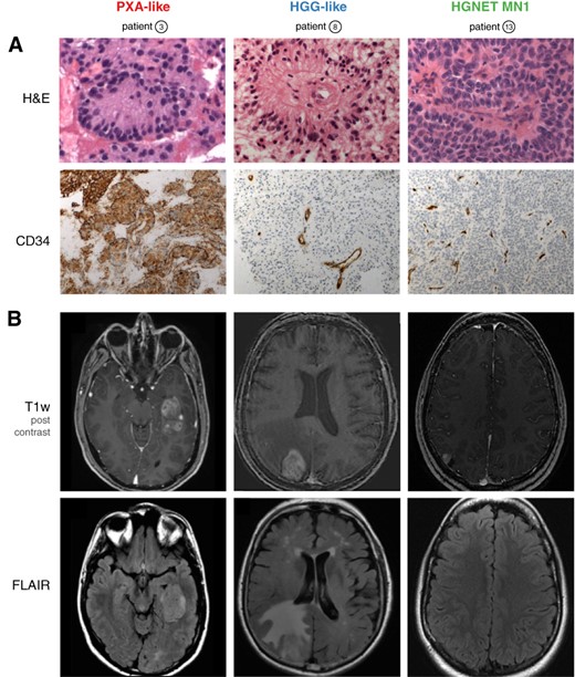 Representative histological (A) and magnetic resonance imaging (MRI) (B) features of subgroups. (A): H&E staining shows large astroblastic pseudorosettes in all cases (upper panel). Unlike HGG and HGNET‐MN1, PXA‐like astroblastoma (ABM) demonstrate an intense cytoplasmic and pericellular expression of CD34 (lower panel). (B): Representative MRI features of subgroups. Axial post‐contrast T1‐weighted magnetic resonance images demonstrate a solid component in all cases (upper panel). Unlike the other subgroups, HGG‐like ABM show moderate‐to‐extensive perifocal edema on FLAIR sequences (lower panel).