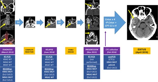 Clinical history and molecular correlates of the patient's sinonasal intestinal‐type adenocarcinoma. Patient story: At diagnosis in March 2013, a right nasoethmoidal solid mass of 3 cm that extended toward the sphenoid sinus was seen, with low 18F‐Fluorodeoxyglucose uptake on positron emission tomography/computed tomography scan (SUVmax 4.4). In June 2014, the tumor relapsed at the right nasal fossa affecting the right maxillary sinus. Radiation therapy was given, achieving stable disease. In November 2015, the tumor progressed with intracranial extension toward the right infratemporal fossa and a second enhancing mass invading the hard palate. It was considered unresectable and RAS and BRAF studies performed using RT‐PCR informed of a KRAS, NRAS, and BRAF wild‐type tumor. Systemic treatment with cetuximab and low‐dose CPT‐11 were administered for 8 consecutive weeks without response. The patient died in April 2016 due to progression of the intracranial component of the tumor. Liquid biopsy and BEAMing studies: CTCs were collected 6 days after the first dose of cetuximab, and IsoFlux system was used for CTC detection, finding 26 CTCs. Among the seven different mutations detectable by castPCR, a mutation was found in KRAS exon 2 codon 12 (pG12A) in DNA from CTCs. Subsequently, BEAMing was performed on the different primary tumor samples, finding mutations in KRAS exon 2 codon 12, and in NRAS exon 2 codon 12. For more details, please refer to the main text and to Figure 3.