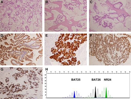 Pathology of the patient's sinonasal intestinal‐type adenocarcinoma. (A–C): (hematoxylin and eosin) Malignant cells forming abnormal glands surrounded by mucinous material, resembling mucinous colorectal adenocarcinoma. The tumor infiltrates surrounding bone. (D–H): Tumor cells intensely stain for CK20 (D), CK7 (E), and CDX2 (F) and show a high proliferative index measured by Ki67 (>70%) (G). Microsatellite study shows that the tumor is “stable” (H). For more details, please refer to the main text.