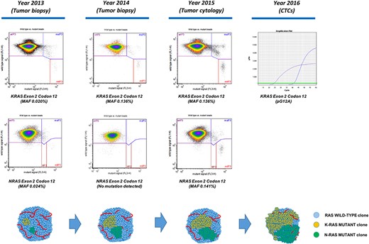 RAS mutations detected in primary tumor and CTCs, using, respectively, BEAMing and castPCR, and proposed model of tumor evolution. Tumor biopsies from 2013 and 2014 and a tumor cytology sample from 2015 were used for RAS analysis with BEAMing. castPCR was used for the study of KRAS mutations in CTCs. Mutations in KRAS and NRAS were already detectable in the tumor biopsy from 2013, with MAF above the established limit of detection for BEAMing (MAF ≥0.01%–0.02%). MAF for KRAS and NRAS increased progressively along tumor evolution achieving MAF ≥0.1%, possibly reflecting the selection of RAS mutant clones over the wild‐type component of the tumor and allowing for a significant shedding of RAS‐mutant tumor cells to the peripheral blood. Studies in advanced colorectal cancer have shown that RAS‐mutant tumors with MAF ≥0.1% do not benefit from anti‐epidermal growth factor receptor therapy, thus possibly explaining the absence of tumor response seen in our patient. BEAMing is considerably more sensitive than castPCR. In contrast to castPCR, BEAMing informs of the mutated codon but not of the specific mutated locus. For more details, please refer to the main text.