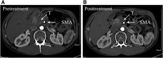 Example of before treatment (A) and after treatment (B) with mFOLFIRINOX with partial response.