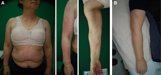 A 63‐year‐old female patient with non‐small cell lung cancer treated with erlotinib (150 mg). (A): Erythematous multiple macules and patches were observed on face, upper extremities, chest, and trunk. (B): Improved skin lesions following 4 weeks of treatment (arm 2; EGF 1 ppm).