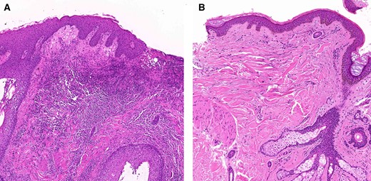 Histopathological findings of Figure 1. (A): Dense dermal infiltration of neutrophils and lymphohistiocytes and spongiosis of epidermis with focal pustular scab formation. (B): Markedly reduced inflammatory cell infiltration after 4 weeks of treatment (arm 2; EGF 1 ppm).