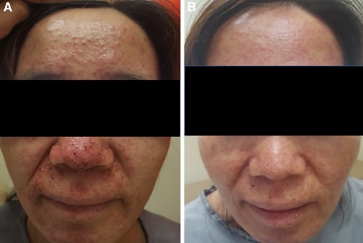 A 54‐year‐old female patient with colon cancer treated with cetuximab‐based regimen. (A): Acneiform papules and pustules, and crusts on the face. (B): Improved skin lesions following 4 weeks of treatment (arm 3; EGF 20 ppm).