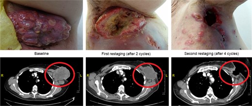 Summary of response in patient with breast cancer. Patient with metastatic triple-negative breast cancer received 8 prior lines of systemic therapy before enrolling in the 10 g once daily monotherapy dose cohort. Best responses of stable disease per RECIST version 1.1 and of partial response (PR) per immune-related RECIST as evidenced by a 51% reduction in axillary mass after 4 cycles were documented. The response was progressive disease per RECIST version 1.1 criteria because of the appearance of a pulmonary nodule. The PR per immune-related RECIST was unconfirmed because of patient hospitalization during cycle 6 for progressive disease and leptomeningeal metastases.