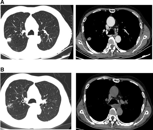 (A): Computed tomography (CT) scan before gefitinib and cetuximab treatment. (B): CT scan showing a partial response after 2 months of gefitinib and cetuximab treatment.