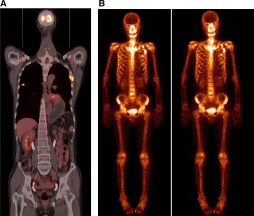 The foci of the left fourth rib turned out to be a fracture 2 months after diagnosis. (A): Positron emission tomography–computed tomography scan showed a right upper lung mass and metastatic foci of the left fourth rib. (B): The foci showed no response to treatment from two consecutive (November 2, 2020, and December 3, 2020) bone scintigraphies (and turned out to be benign, as revealed by bone biopsy).