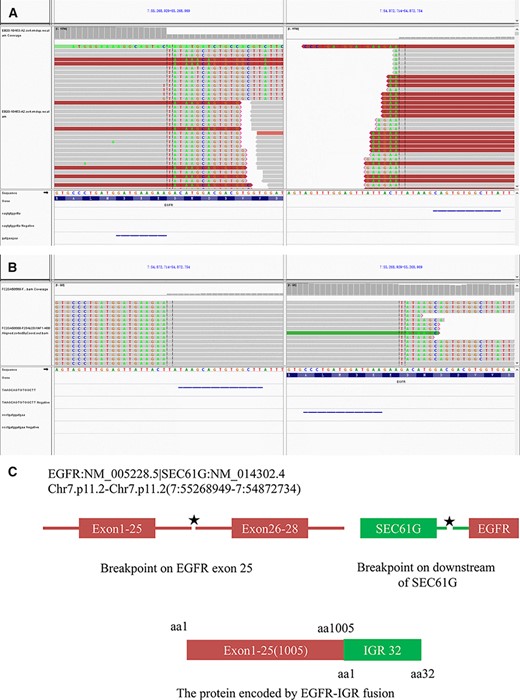 (A): Integrative Genomics Viewer snapshot of EGFR–intergenic region (IGR) fusion (DNA analysis). (B): Integrative Genomics Viewer snapshot of EGFR-IGR (RNA analysis). (C): Schematic representation of the EGFR-IGR fusion protein domain structure.