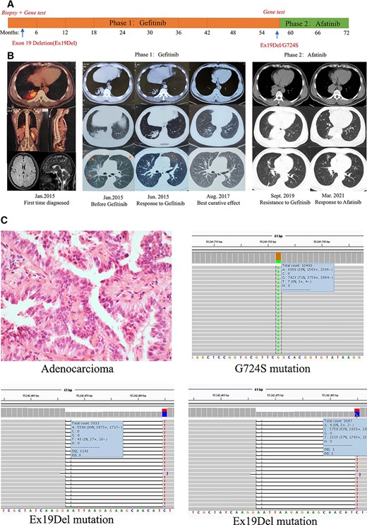 (A): Timeline of treatment. (B): Computed tomography scan images of the patient's clinical course. (C): Pathology and gene tests results.