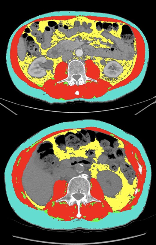 Comparison of segmentation results (teal: subcutaneous fat, red: skeletal muscle, green: intermuscular fat, yellow: visceral fat) between two patients with similar body mass index (BMI). The first patient (top panel) had a BMI of 25.3, skeletal muscle index (SMI) of 53.2 (high), a skeletal muscle (SM) mean of 51.1 (high) and myosteatosis percentage of 2.79% (low). This patient had a best response of complete response and continues to be progression-free 47 months after ICI initiation. The second patient (bottom panel) had a BMI of 23.6, an SMI of 39.6 (low), an SM mean of 29.2 (low), and myosteatosis of 8.89 % (high). This patient had progressive disease as their best radiographic response and passed away within 2 months of ICI initiation.