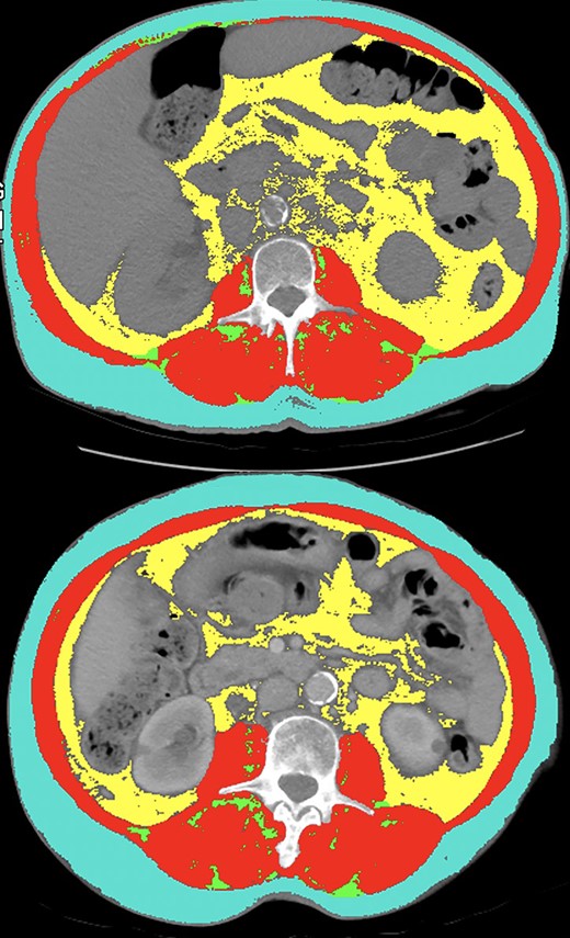 Comparison between two female patients in this study with similar body mass index, (BMI), skeletal muscle index (SMI; red), subcutaneous fat index (SFI; teal), but disparate visceral fat index (VFI; yellow). The first patient (top panel) had a BMI of 25.1, SMI of 50.37 (high), SFI of 45.98 (low), and VFI of 50.92 (high). This patient had partial response as their best response and remains progression-free for 15.8 months. The second patient (bottom panel) had a BMI of 26.5, SMI of 52.2 (high), SFI of 50.2 (low) and VFI of 30.16 (low). This patient experienced radiographic progression on their first restaging scan and passed away within 3 months of ICI initiation.