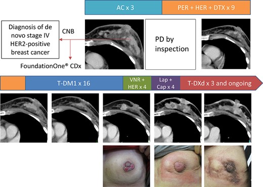 Computed tomography images and photographs of the left breast over the treatment course. Abbreviations: AC, doxorubicin + cyclophosphamide; Cap, capecitabine; CNB, core needle biopsy; Lap, lapatinib; PD, progressive disease; PER + HER + DTX, pertuzumab + trastuzumab + docetaxel; T-DM1, ado-trastuzumab emtansine; T-DXd, fam-trastuzumab deruxtecan; VNR, vinorelbine.