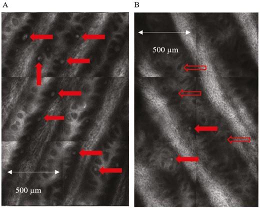 In vivo reflectance confocal images of Meissner’s corpuscles. Enlarged view of quadrants from an “optical biopsy” mosaic obtained from the fingertip (digit V) of (A) healthy control and (B) patient at baseline prior to treatment. Meissner’s corpuscles (MCs) which appear as bright, ovoid white structures are normally located in the dermal papillae and are indicated by the solid red arrows. The open red arrows show empty dermal papillae which appear as dark regions due to the absence of MCs. The comparison highlights the difference in MC density between the two groups.