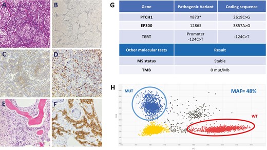 Pathology findings, next-generation sequencing results, and digital PCR analyses of the primary tumor. (A) Desmoplastic/nodular MB with nodular pattern (pale islands surrounded by densely packed poorly differentiated cells; H&E, 200×). (B) The presence of peripheral reticulin-rich areas surrounding well-developed reticulin-poor nodules with neuronal differentiation is one of the most diagnostically helpful features for the desmoplastic/nodular MB variant (Reticulin, 100×). (C) Neuronal differentiation shown by moderate immunoreactivity for sinaptophysin in the pale nodes (Sinaptophysin, 200×). (D) Ki-67 antibody staining shows that proliferative activity predominates in the highly cellular internodular areas (Ki-67, 200×). Bone marrow infiltrated by poorly differentiated cells (E, H&E, 100×) which are CD56-positive, corresponding to metastasis of MB (F, CD56, 400×). (G) The findings of the molecular NGS study (Foundation One CDx) of the primary tumor are shown. (H) Results of the digital PCR of the PTCH1 Y873* mutation in the primary tumor. Encircled left upper dots indicate the mutant fraction. Encircled right lower dots indicate the wild-type fraction.