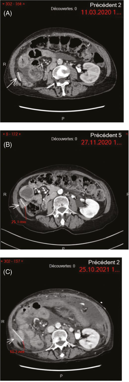 Three abdominal MRI scans annotate and measure the trajectory of a peritoneal carcinosis target-lesion across key dates: Figure 1 captures 11.03.2020 as the Erdafitinib starting point, 27.11.2020 during stable disease post-toxicity-related discontinuation, and 25.10.2021 marking Pemigatinib initiation with progressive disease.