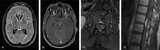 MRI findings at initial presentation included periventricular and sulcal hyperintensity with subtle leptomeningeal enhancement within the brain, enhancement of the cauda equina and spinal cord surface, as well as mass-like enhancement within the thoracic spinal cord.