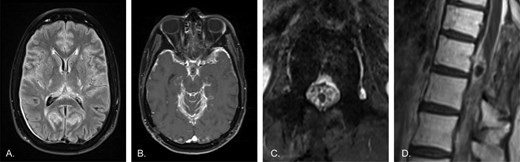 MRI findings at time of disease progression were notable for thicker diffuse enhancement outlining the leptomeninges within the brain, cauda equina, and spinal cord surface. the spinal cord mass persisted, with post-biopsy related changes.