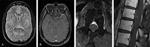 MRI findings following 3 months of treatment with tovorafenib demonstrate marked improvement in leptomeningeal, cauda equina, spinal cord surface, and spinal cord mass enhancement compared with original presentation.